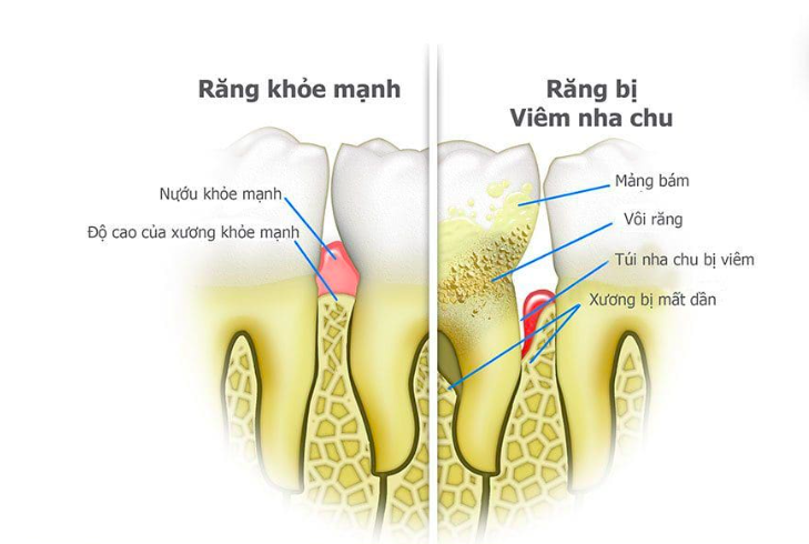 Bài 1: Cạo Vôi Răng – Điều Trị Nha Chu