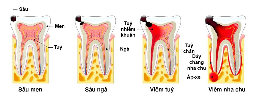 Cac-giai-doan-sau-rang