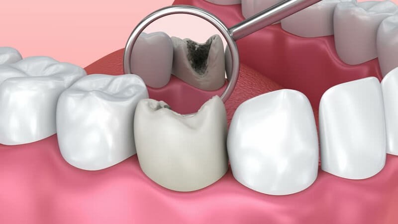 Những dấu hiệu nhận biết răng có bị sâu hay không?