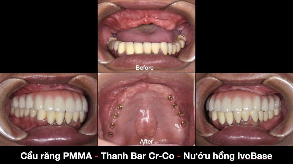 Chỉ định Zygoma hay cấy Implant 2 thì lựa chọn an toàn, ít biến chứng ( ở thì tương lai ) hơn cho bệnh nhân.