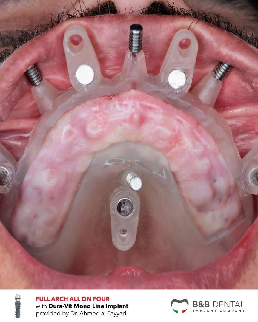 định Vị Máng Hình 1 Nha Khoa Chia Sẻ