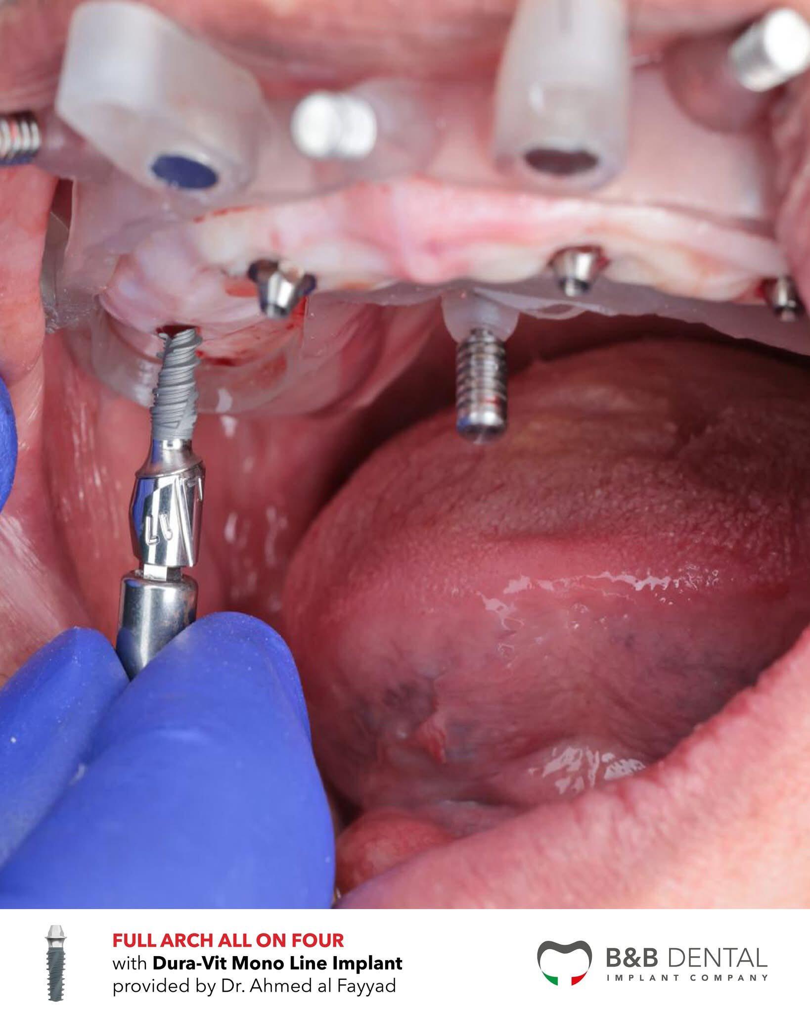 Vặn Implant Nha Khoa Chia Sẻ